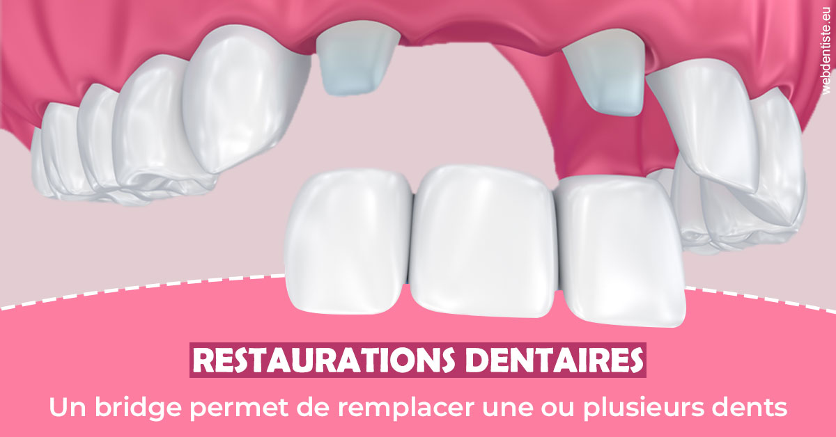 https://www.docteur-mandalova.fr/Bridge remplacer dents 2