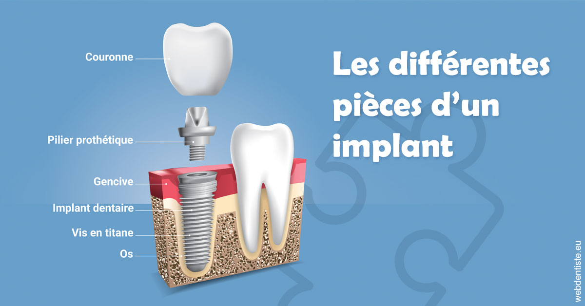 https://www.docteur-mandalova.fr/Les différentes pièces d’un implant 1